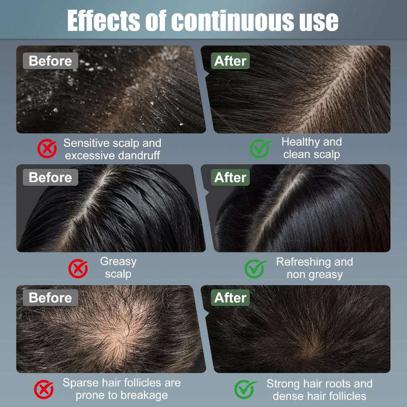 Laser scalp Therapy Comb Splashis 9-speed-massager adjustable-intensity advanced-technology affordable-luxury age-related-thinning aging-reversal alopecia-treatment anagen-activation anti-hair-loss anti-inflammatory antibacterial-therapy
