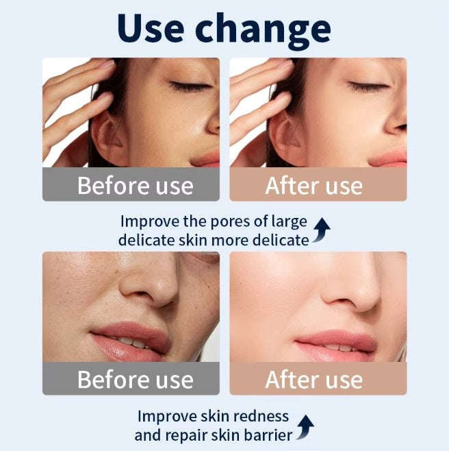 Multi-color LED photon skin rejuvenation Splashis accessible-technology acne-fighting acne-scar-treatment acne-treatment adjustable-mask adult-acne affordable-luxury age-eraser age-spot-reducer ageless-beauty all-skin-tones all-skin-types